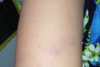 Bekas luka penganiayaan yang dilakukan oleh tetangganya sendiri (dok. Harianjatim.id)