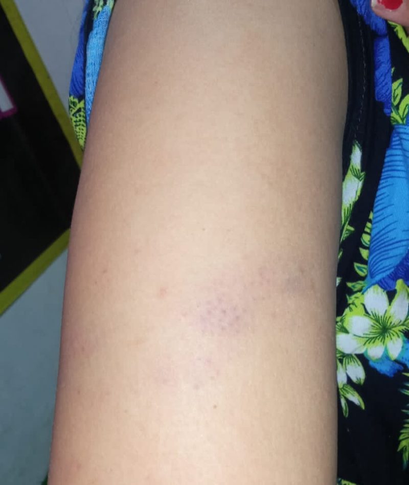 Bekas luka penganiayaan yang dilakukan oleh tetangganya sendiri (dok. Harianjatim.id)